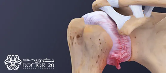 شانه یخ زده چیست؟ چگونه درمان می شود؟